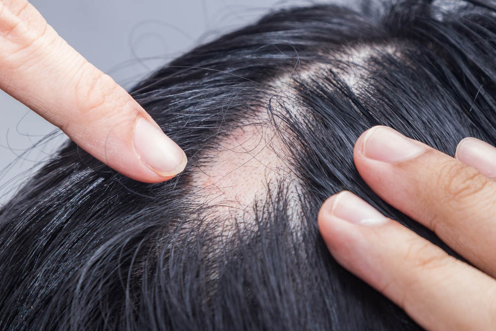 Kreisrunder Haarausfall (alopecia areata)