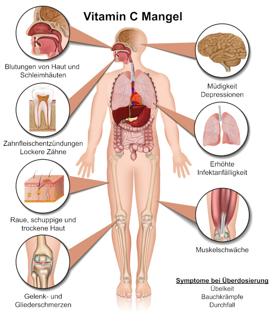 Skizze zeigt Auswirkungen von Vitamin C Mangel im Körper